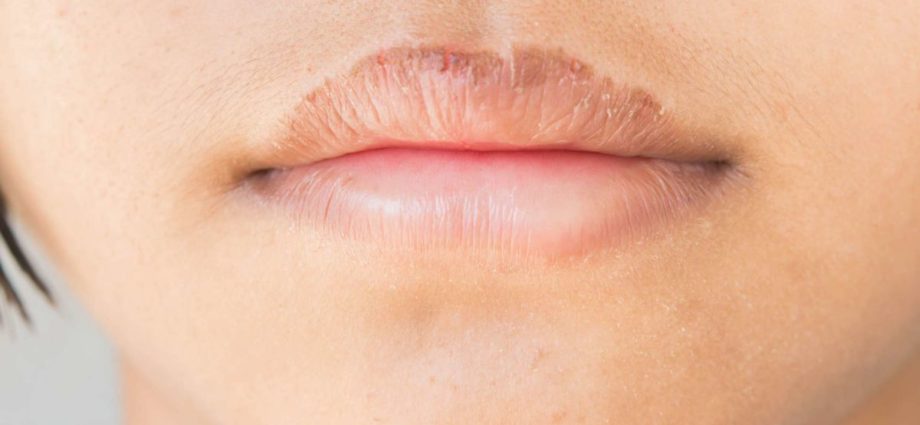 Dry lips: what to do