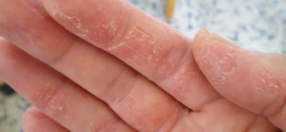 Dry skin of the hands that peels off on the palms: causes and what to do