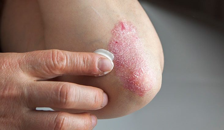 Dry skin on elbows