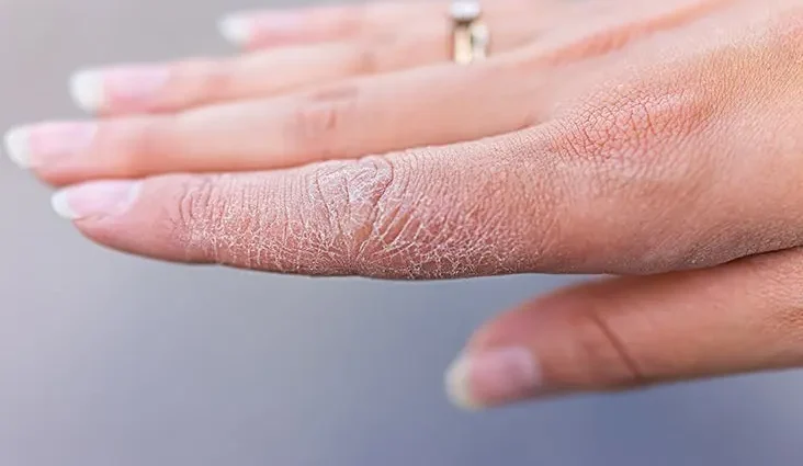 Dry skin on fingers