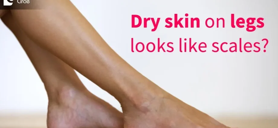 Dry skin on the legs