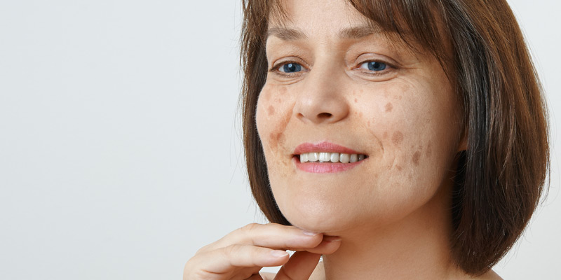 EXPERT COLUMN. When and how to get rid of age spots?