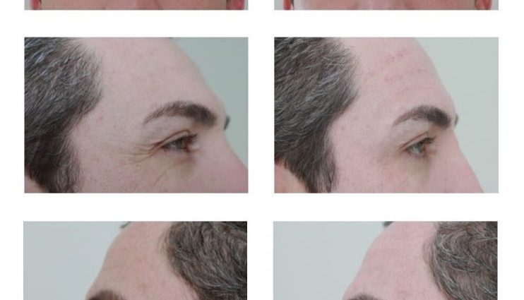 Feel the difference: fractional mesotherapy