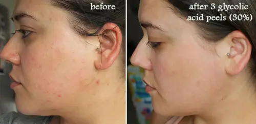 Glycolic peeling