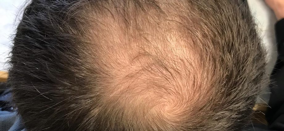 Hair loss in men