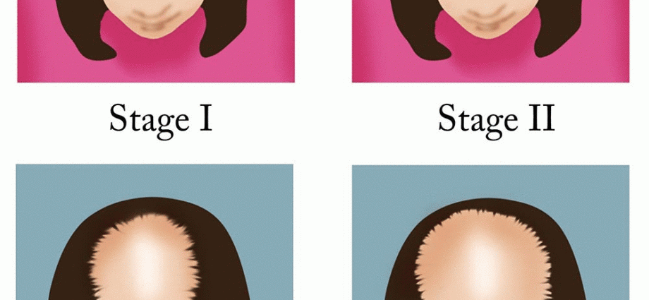 Hair loss in women