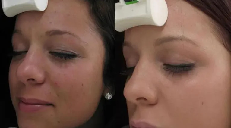 How often can a face peel be done?