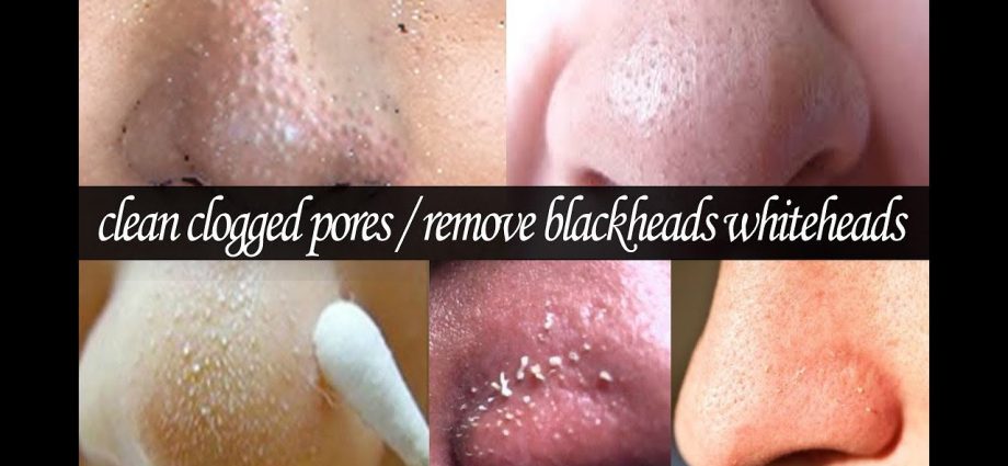 How to clear pores from blackheads