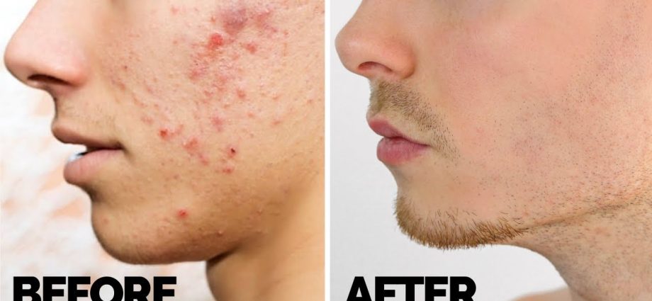 How to get rid of acne on the face