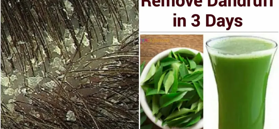 How to get rid of dandruff forever