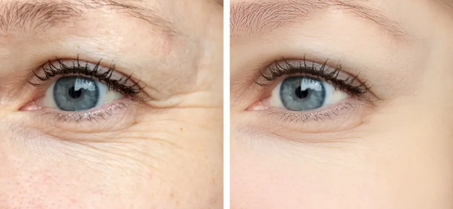 How to remove wrinkles under the eyes and is it possible at all