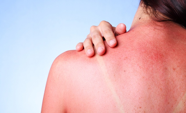 How to smear the skin after sunburn