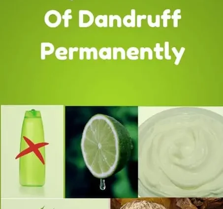 Is it possible to get rid of dandruff forever