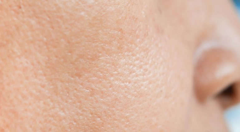 Is it possible to shrink pores once and for all