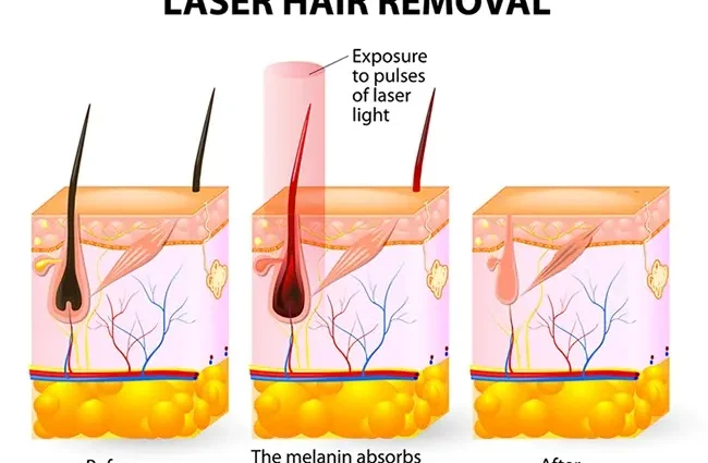 Laser hair removal: pros and cons