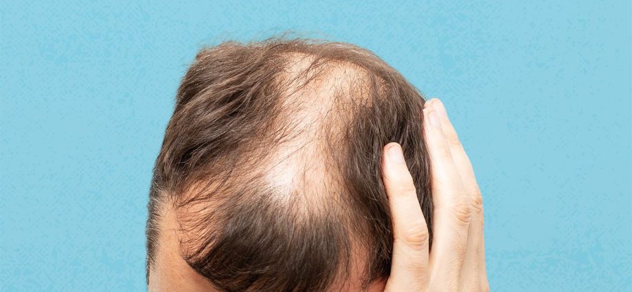 Let&#8217;s count: causes of hair loss