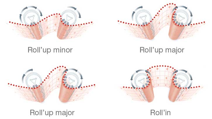 LPG massage: how it works