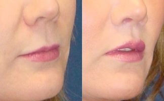 Mouth-front: how to raise the corners of the lips