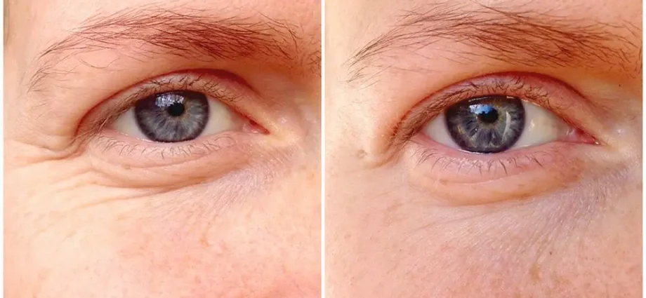 Oil for wrinkles around the eyes