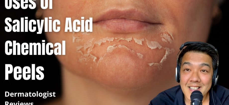 Peeling with salicylic acid