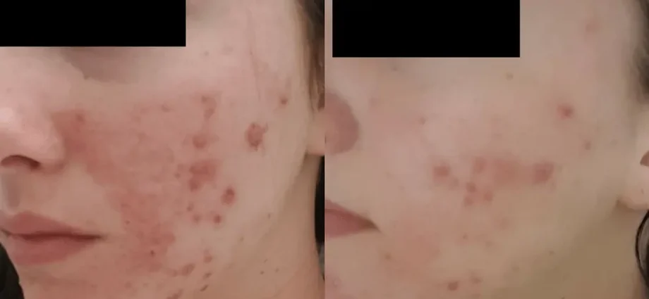 Pimples after peeling