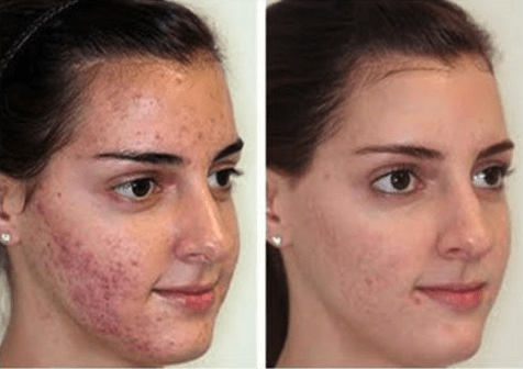 Post-acne peeling