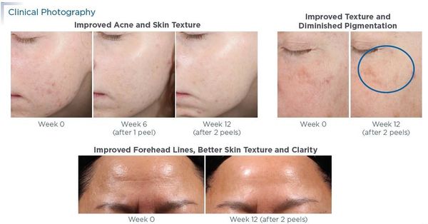 Retinol facial peel