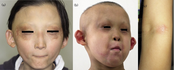 School of children&#8217;s skin: diathesis in a child