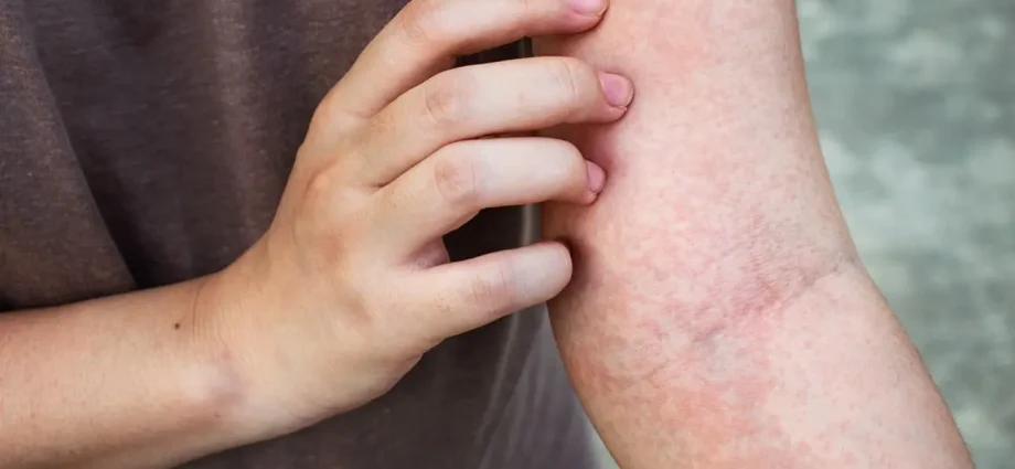 Skin itching all over the body: what are the causes and how to get rid of discomfort?