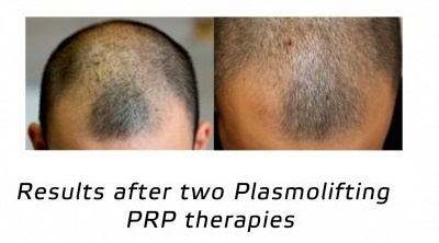 Strengthen in place: plasmolifting for hair