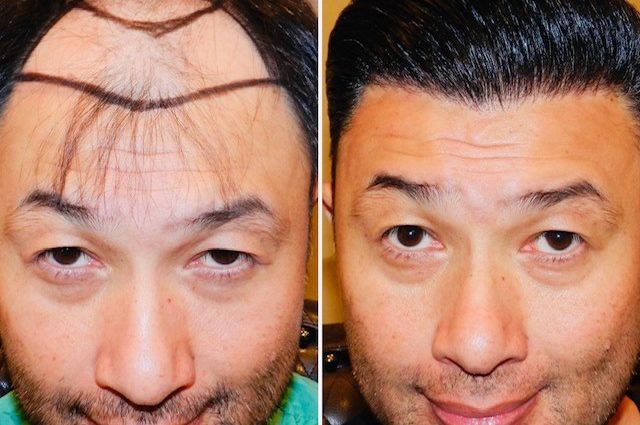 The most effective hair restoration procedures