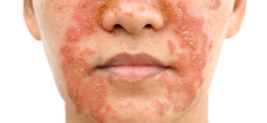 Types of rashes on the face