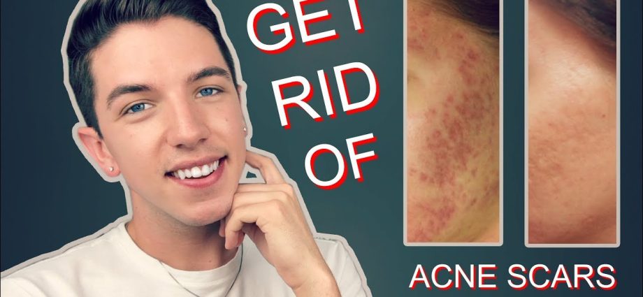 Video: how to get rid of post-acne?