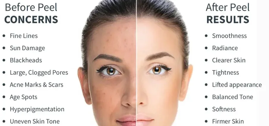 What is a facial peel?