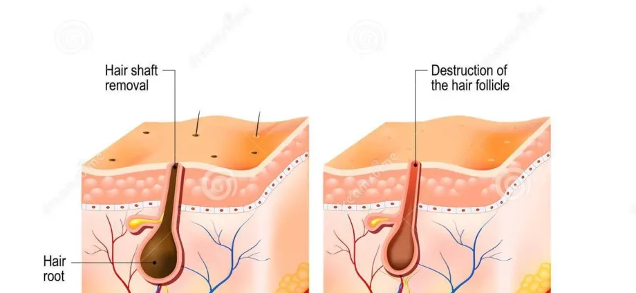 What is the difference between depilation and epilation