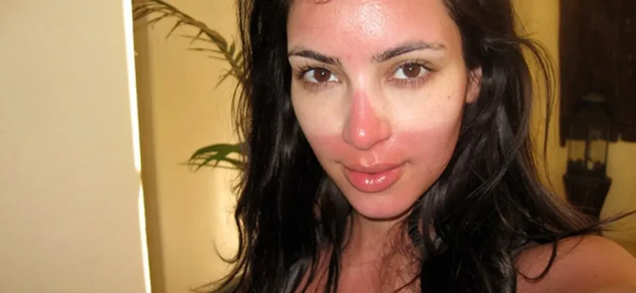 What to do if your skin gets sunburned