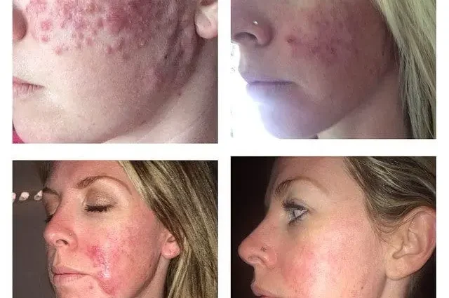 Why do acne appear on the cheeks and how to eliminate them?