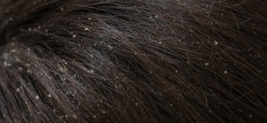 Why does the scalp flake and what to do about it?