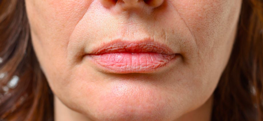 With the mouth of a baby: how to remove wrinkles above the upper lip