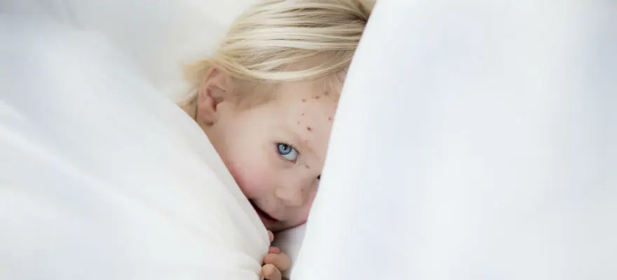 diet for chickenpox in children 5 years old