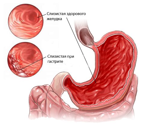 gastritis schematically